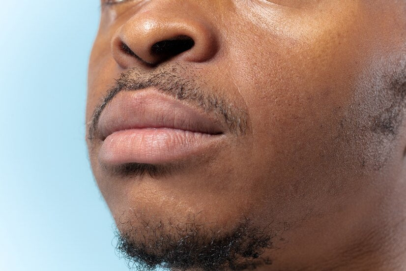 Nasolabial fold filler is a cosmetic treatment that aims to hide the nasolabial folds.