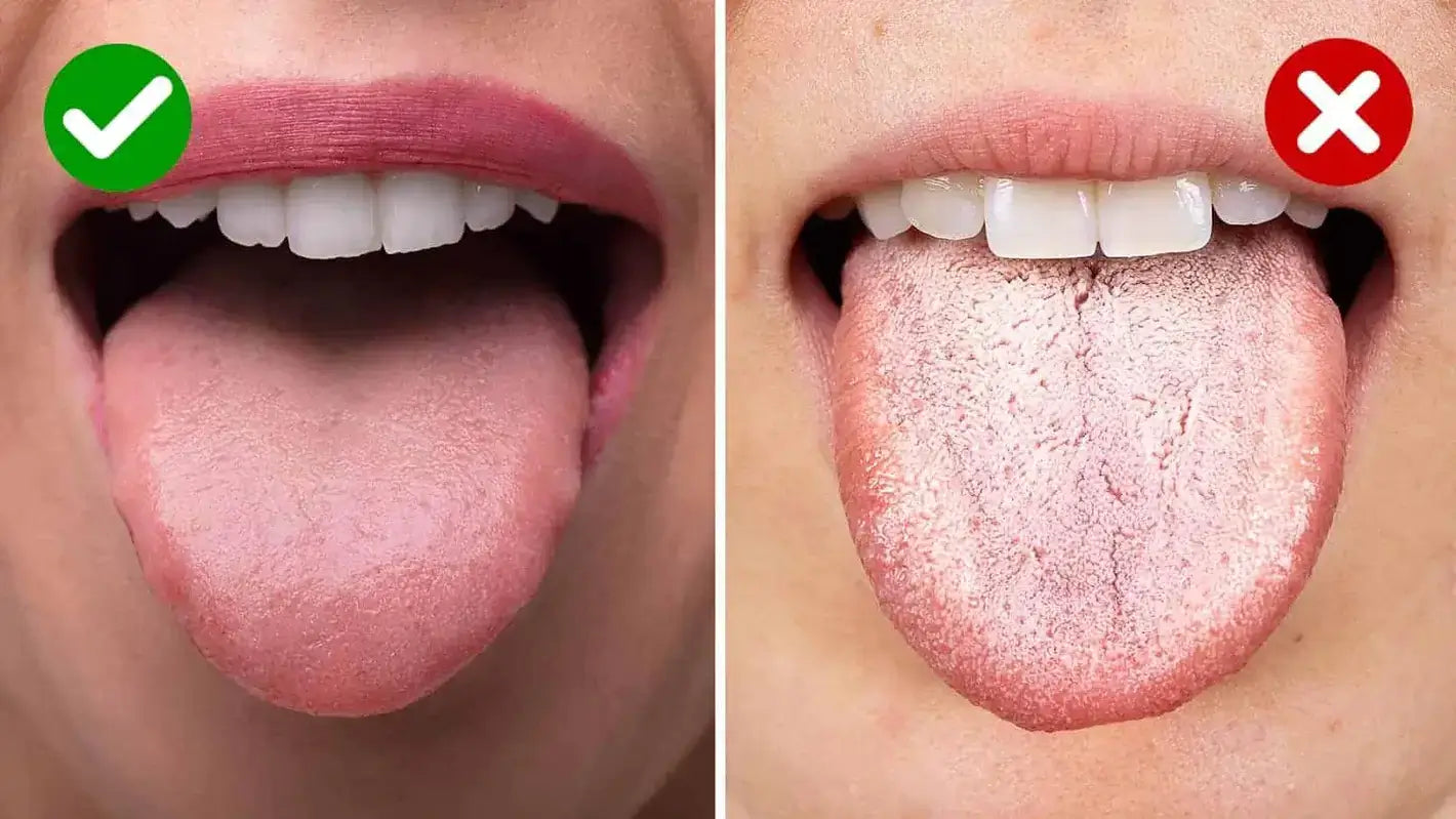 White Tongue: Causes, Treatments & Prevention