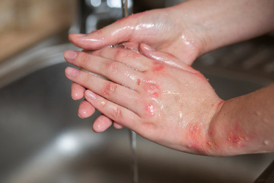 Is Hot Water Bottle Rash Dangerous?