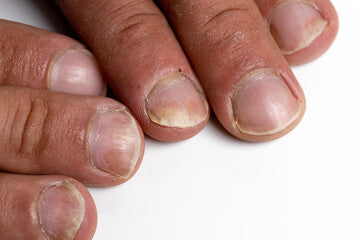 Nail Psoriasis is a specific type of psoriatic disease influencing nail health, while Onychomycosis, commonly known as nail fungus, is a prevalent condition characterised by the invasion of microscopic organisms—fungi—in nails.