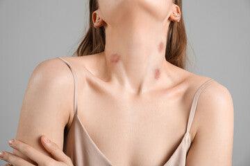 5 Ways to Get Rid of Hickies Instantly - welzo