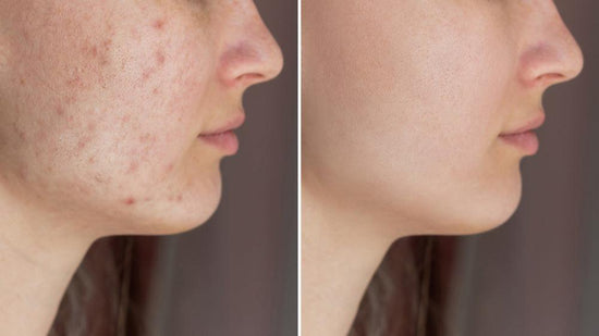 7 Acne Causing Foods According to Doctors - welzo