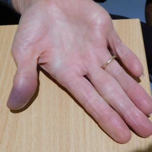 Achenbach syndrome is a benign self limiting condition that involves bruising of the finger