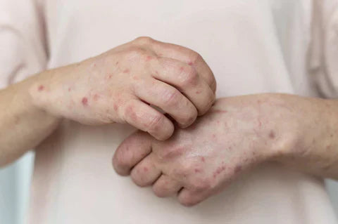 Different types of warts and their clinical picture