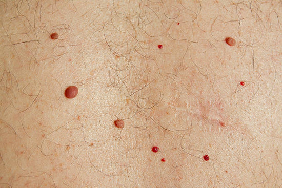 Cherry angiomas are benign, small, red bumps on the skin