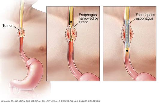 Esophageal Cancer Diagnosis - welzo