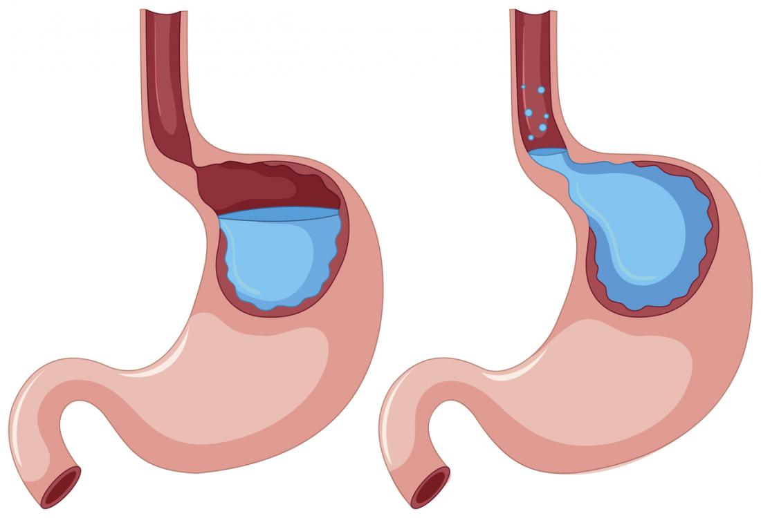 Probiotic strains designed to survive stomach acid and support gut health
