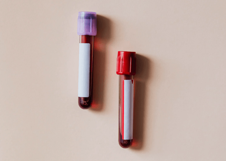 Haemochromatosis (Iron Overload) - Everything You Need to Know - welzo