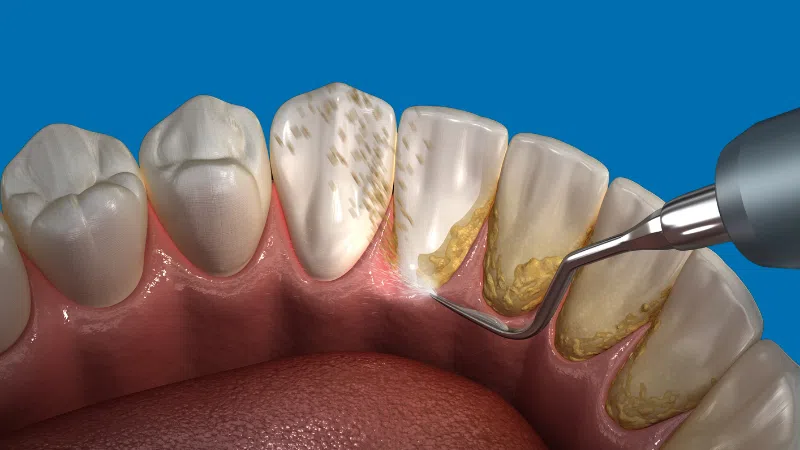 Calculus Bridge: Causes, Risks and Treatment