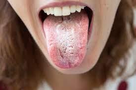 Is Thrush Contagious? Prevention, Complications and More - welzo
