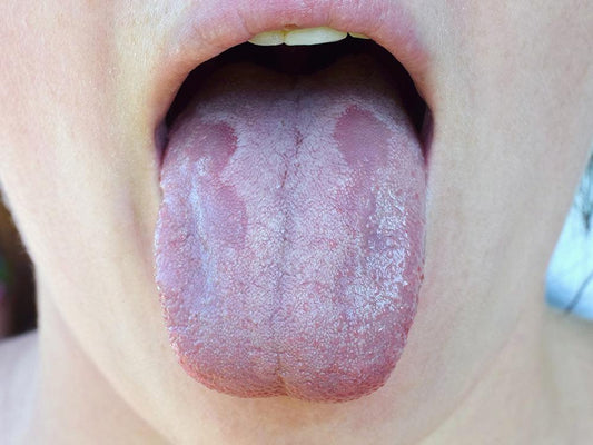 Oral Thrush: Symptoms, Causes, Treatments, and Prevention - welzo