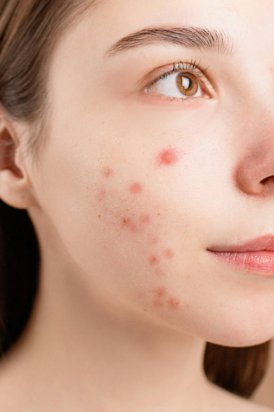 Hydrocolloid Patches for Pimples: Do they work and what are they?