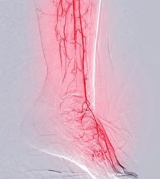 PAD  is a circulatory issue where constricted blood vessels lead to reduced blood flow in the limbs.