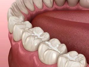 a temporary filling is a stopgap treatment used to seal a tooth cavity until the permanent filling is completed