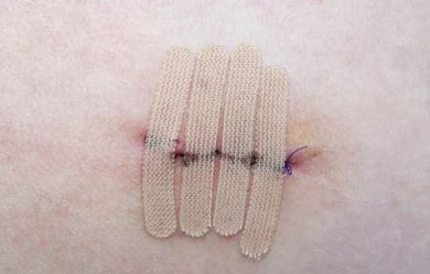 Steri-Strips are narrow tapes applied chiefly on minor injury sites or surgical cuts.