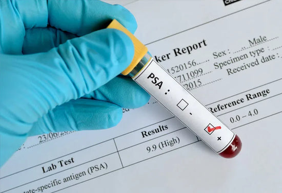 Prostate cancer screening: Should you get a PSA test? - welzo