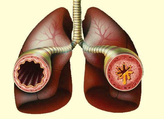 Reactive Airway Disease: Is it asthma? - welzo