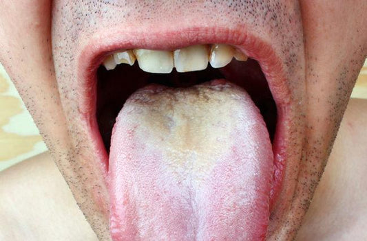 Thrush on Tongue: Causes, Symptoms, and Treatment - welzo