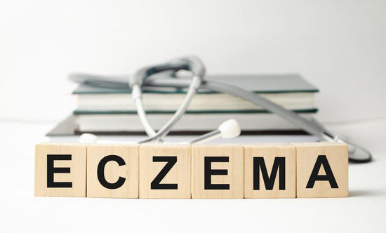 Treatment of Eczema - welzo