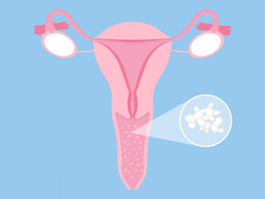 Vaginal Thrush: Causes, Symptoms, and Treatment - welzo