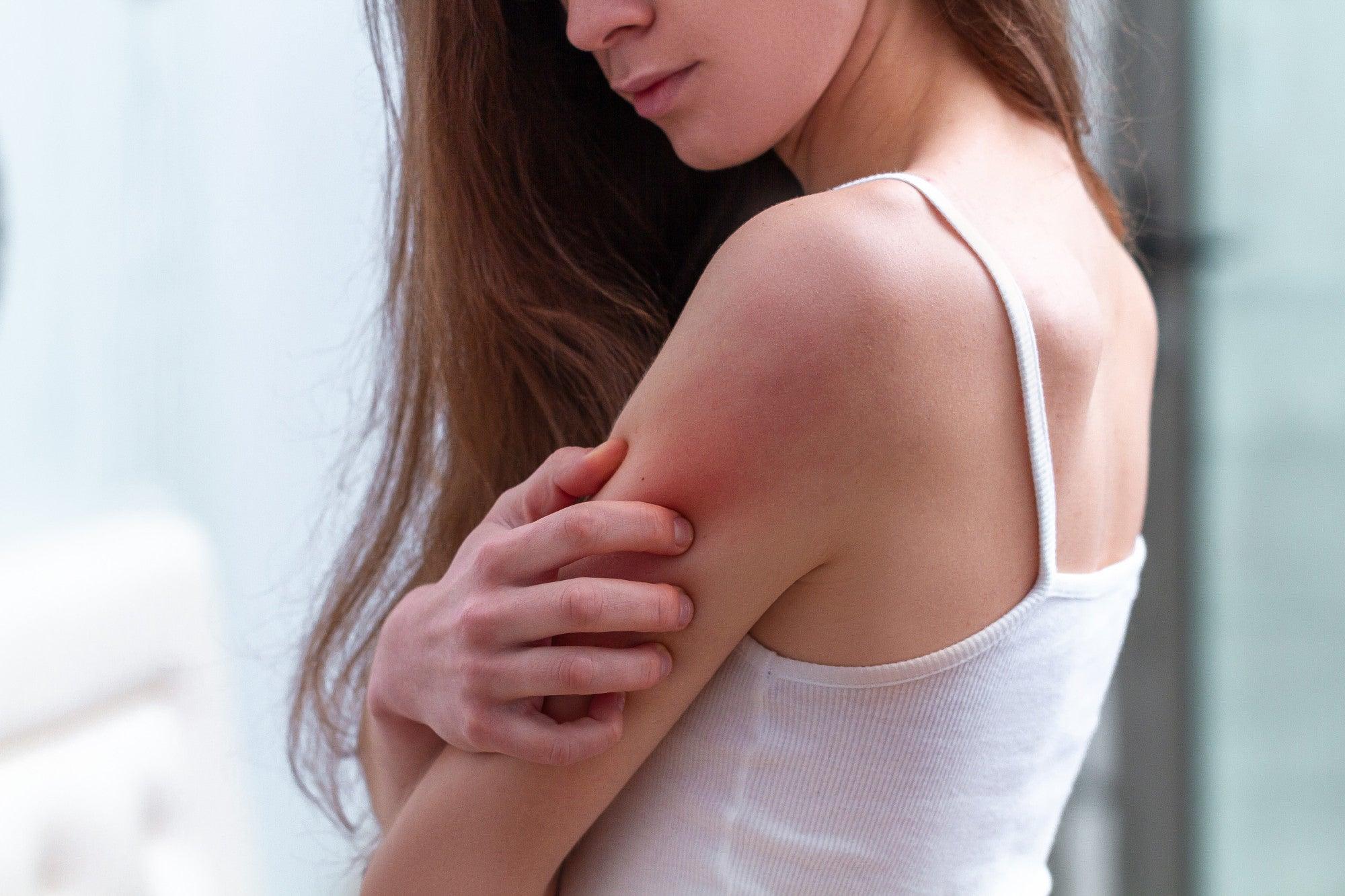What Does an Allergic Reaction Heat Rash Look Like?