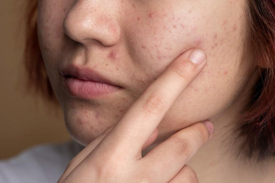 What Type Of Acne Do I Have - welzo