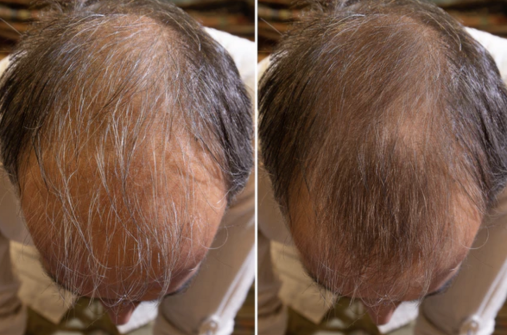 Cappello a infrarossi in luce rossa Welzo ad alto dosaggio terapia di crescita dei capelli
