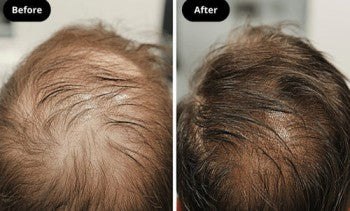 Rood licht infraroodhoed Welzo High Dosage Hair Growth Therapy