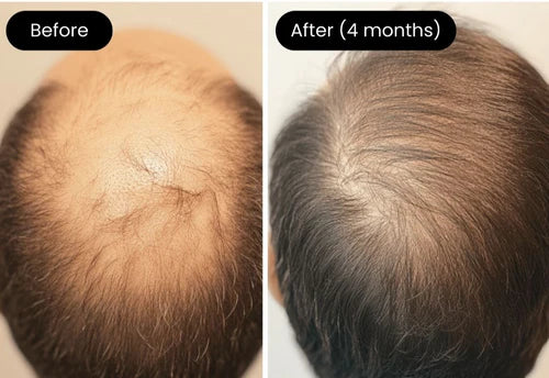 Κόκκινο φως υπέρυθρης καπέλο Welzo High Dosage Hair Growth θεραπεία