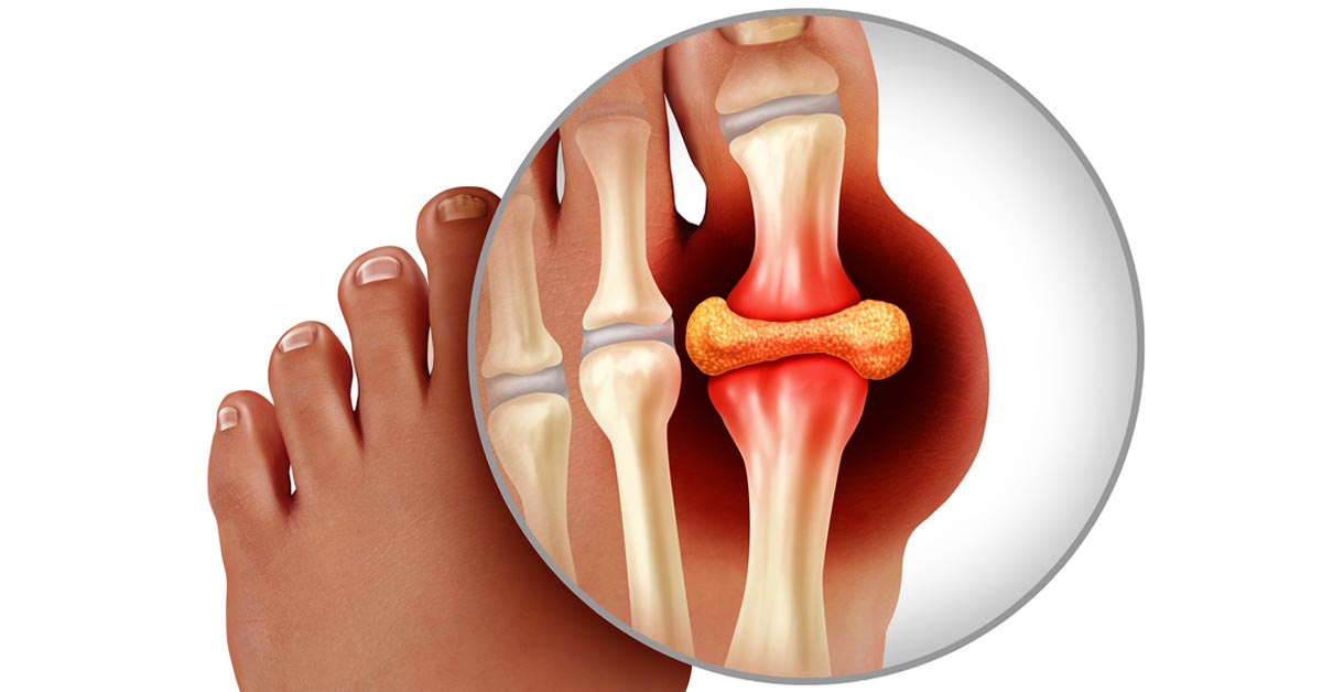 Carica video: Sollievo dal dolore Gout